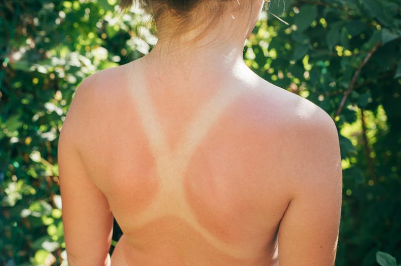 What to do when you're accidentally sunburnt